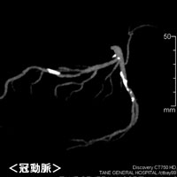 冠動脈画像